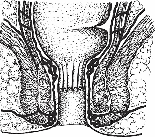 Геморрой. Излечение без операции Геморрой. Излечение без операции