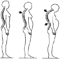 Остеопороз. Тихая эпидемия XXI века Остеопороз. Тихая эпидемия XXI века