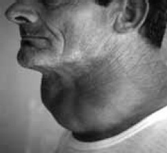 Заболевания щитовидной железы. Лечение и профилактика Заболевания щитовидной железы. Лечение и профилактика