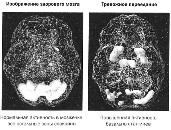 Мозг против лишнего веса Мозг против лишнего веса