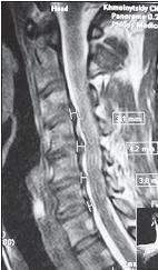 Остеохондроз для профессионального пациента Остеохондроз для профессионального пациента