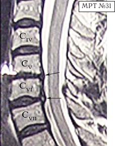 Остеохондроз для профессионального пациента Остеохондроз для профессионального пациента