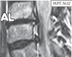 Остеохондроз для профессионального пациента Остеохондроз для профессионального пациента