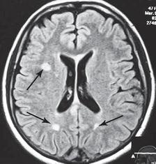 Остеохондроз для профессионального пациента Остеохондроз для профессионального пациента