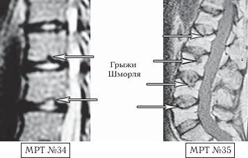 Остеохондроз для профессионального пациента Остеохондроз для профессионального пациента