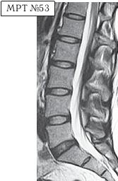 Остеохондроз для профессионального пациента Остеохондроз для профессионального пациента