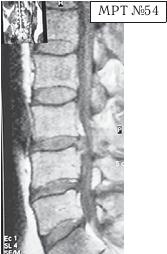 Остеохондроз для профессионального пациента Остеохондроз для профессионального пациента