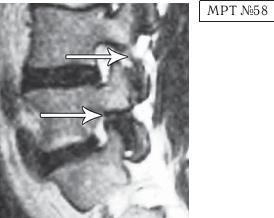Остеохондроз для профессионального пациента Остеохондроз для профессионального пациента