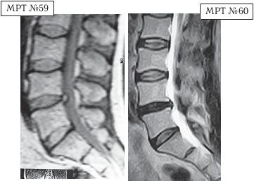 Остеохондроз для профессионального пациента Остеохондроз для профессионального пациента