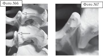 Остеохондроз для профессионального пациента Остеохондроз для профессионального пациента