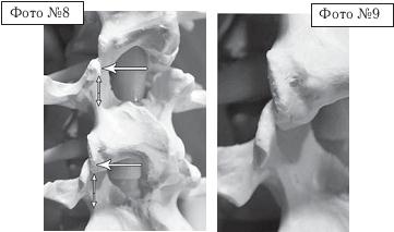 Остеохондроз для профессионального пациента Остеохондроз для профессионального пациента