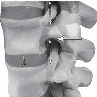 Остеохондроз для профессионального пациента Остеохондроз для профессионального пациента