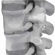 Остеохондроз для профессионального пациента Остеохондроз для профессионального пациента