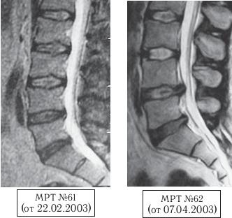 Остеохондроз для профессионального пациента Остеохондроз для профессионального пациента