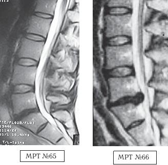 Остеохондроз для профессионального пациента Остеохондроз для профессионального пациента