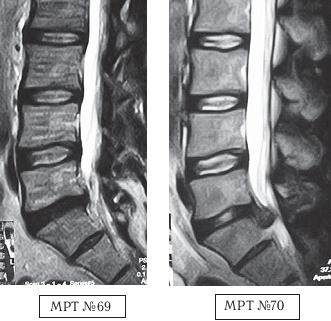 Остеохондроз для профессионального пациента Остеохондроз для профессионального пациента
