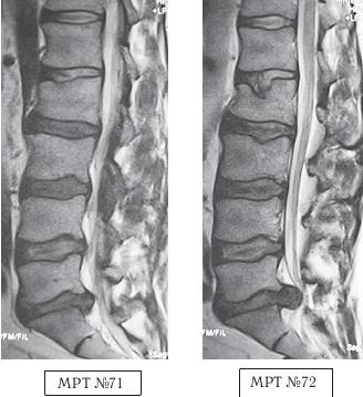 Остеохондроз для профессионального пациента Остеохондроз для профессионального пациента