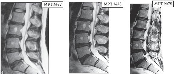Остеохондроз для профессионального пациента Остеохондроз для профессионального пациента