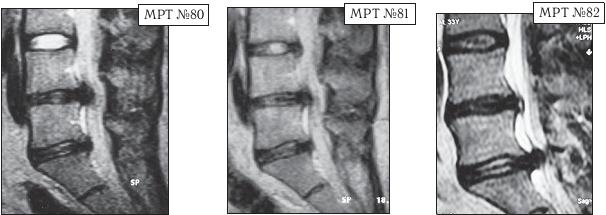 Остеохондроз для профессионального пациента Остеохондроз для профессионального пациента