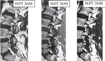 Остеохондроз для профессионального пациента Остеохондроз для профессионального пациента