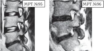 Остеохондроз для профессионального пациента Остеохондроз для профессионального пациента