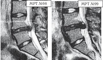 Остеохондроз для профессионального пациента Остеохондроз для профессионального пациента