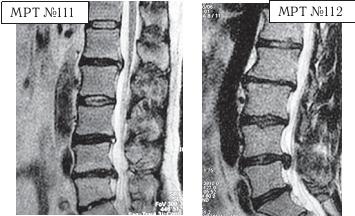 Остеохондроз для профессионального пациента Остеохондроз для профессионального пациента