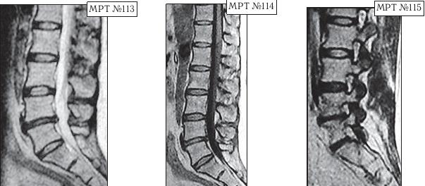 Остеохондроз для профессионального пациента Остеохондроз для профессионального пациента