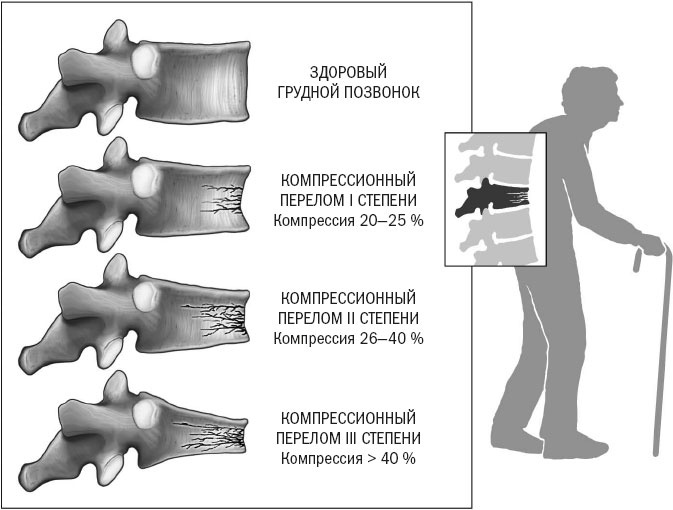 Йога при остеопорозе Йога при остеопорозе