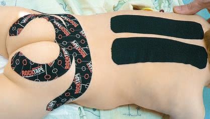 Кинезиотейпинг в лечебной практике неврологии и ортопедии Кинезиотейпинг в лечебной практике неврологии и ортопедии