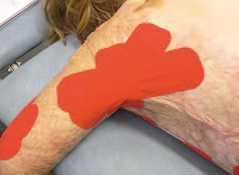 Кинезиотейпинг в лечебной практике неврологии и ортопедии Кинезиотейпинг в лечебной практике неврологии и ортопедии