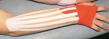 Кинезиотейпинг в лечебной практике неврологии и ортопедии Кинезиотейпинг в лечебной практике неврологии и ортопедии