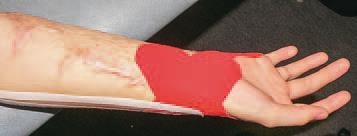 Кинезиотейпинг в лечебной практике неврологии и ортопедии Кинезиотейпинг в лечебной практике неврологии и ортопедии