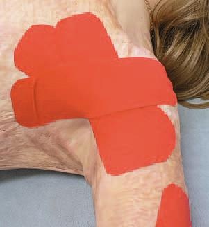 Кинезиотейпинг в лечебной практике неврологии и ортопедии Кинезиотейпинг в лечебной практике неврологии и ортопедии