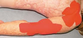 Кинезиотейпинг в лечебной практике неврологии и ортопедии Кинезиотейпинг в лечебной практике неврологии и ортопедии