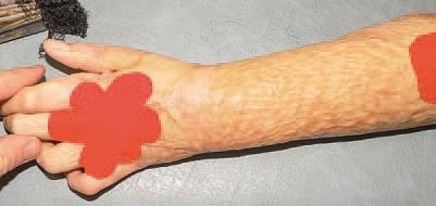 Кинезиотейпинг в лечебной практике неврологии и ортопедии Кинезиотейпинг в лечебной практике неврологии и ортопедии