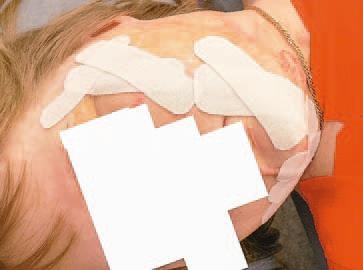 Кинезиотейпинг в лечебной практике неврологии и ортопедии Кинезиотейпинг в лечебной практике неврологии и ортопедии