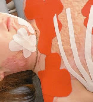 Кинезиотейпинг в лечебной практике неврологии и ортопедии Кинезиотейпинг в лечебной практике неврологии и ортопедии