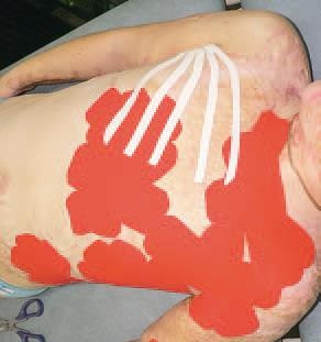 Кинезиотейпинг в лечебной практике неврологии и ортопедии Кинезиотейпинг в лечебной практике неврологии и ортопедии