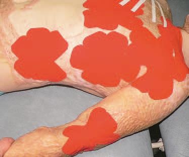 Кинезиотейпинг в лечебной практике неврологии и ортопедии Кинезиотейпинг в лечебной практике неврологии и ортопедии