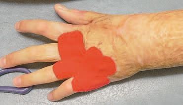 Кинезиотейпинг в лечебной практике неврологии и ортопедии Кинезиотейпинг в лечебной практике неврологии и ортопедии