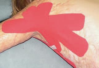 Кинезиотейпинг в лечебной практике неврологии и ортопедии Кинезиотейпинг в лечебной практике неврологии и ортопедии