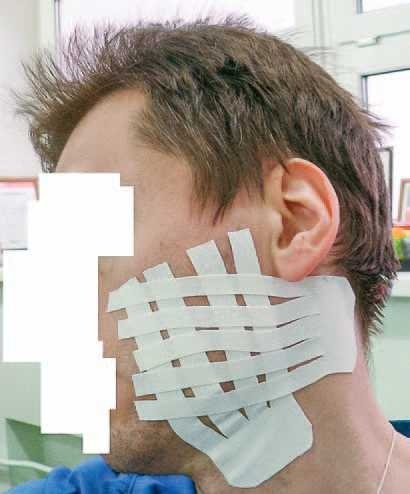 Кинезиотейпинг в лечебной практике неврологии и ортопедии Кинезиотейпинг в лечебной практике неврологии и ортопедии