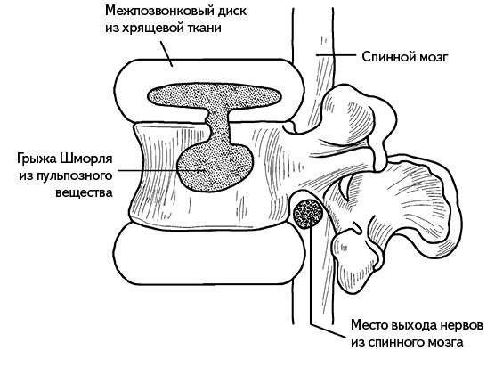 Жизнь без боли в спине. Лечение сколиоза, остеопороза, остеохондроза, межпозвонковой грыжи без операции Жизнь без боли в спине. Лечение сколиоза, остеопороза, остеохондроза, межпозвонковой грыжи без операции