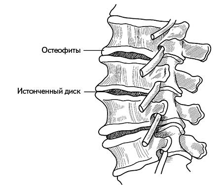 Жизнь без боли в спине. Лечение сколиоза, остеопороза, остеохондроза, межпозвонковой грыжи без операции Жизнь без боли в спине. Лечение сколиоза, остеопороза, остеохондроза, межпозвонковой грыжи без операции