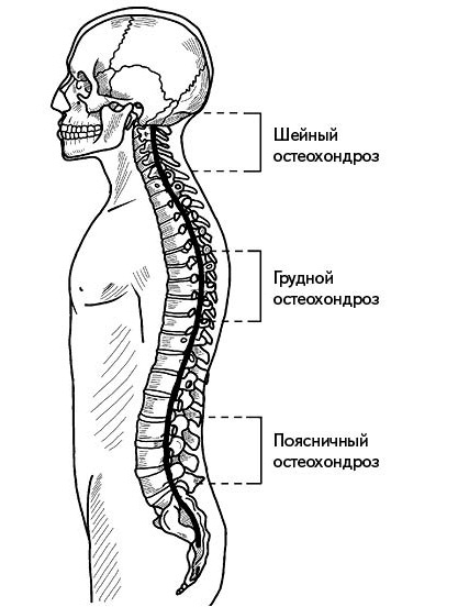 Жизнь без боли в спине. Лечение сколиоза, остеопороза, остеохондроза, межпозвонковой грыжи без операции Жизнь без боли в спине. Лечение сколиоза, остеопороза, остеохондроза, межпозвонковой грыжи без операции
