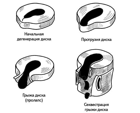Жизнь без боли в спине. Лечение сколиоза, остеопороза, остеохондроза, межпозвонковой грыжи без операции Жизнь без боли в спине. Лечение сколиоза, остеопороза, остеохондроза, межпозвонковой грыжи без операции