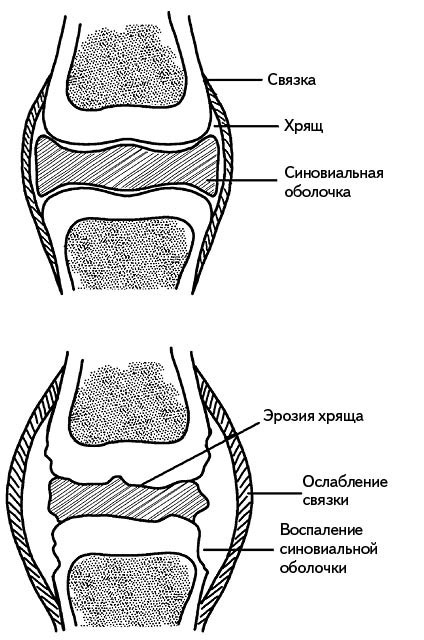 Жизнь без боли в спине. Лечение сколиоза, остеопороза, остеохондроза, межпозвонковой грыжи без операции Жизнь без боли в спине. Лечение сколиоза, остеопороза, остеохондроза, межпозвонковой грыжи без операции