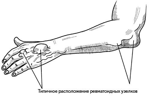 Жизнь без боли в спине. Лечение сколиоза, остеопороза, остеохондроза, межпозвонковой грыжи без операции Жизнь без боли в спине. Лечение сколиоза, остеопороза, остеохондроза, межпозвонковой грыжи без операции