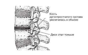 Боль в спине. Как определить причину и устранить приступ Боль в спине. Как определить причину и устранить приступ
